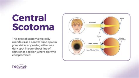 scotomaphobia|Scotoma (Blind Spot in Vision): Types, Causes & Treatment